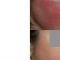 Procedure laser in dermatologia estetica