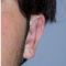 Operazione orecchie (Otoplastica)