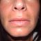 Filler antirughe a base di acido ialuronico