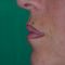 Ingrandimento labbra con grasso (lipofilling)
