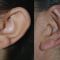 Operazione orecchie (Otoplastica)