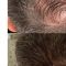 Trapianto capelli