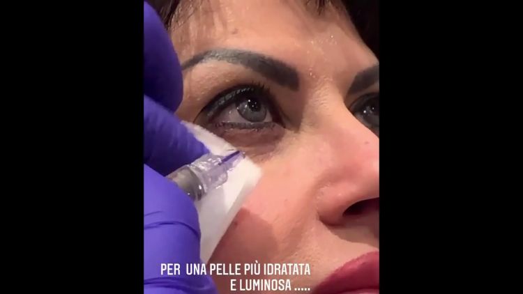 Contorno occhi e contorno labbra con microrughe o da idratare - Dott. Donato Bellone