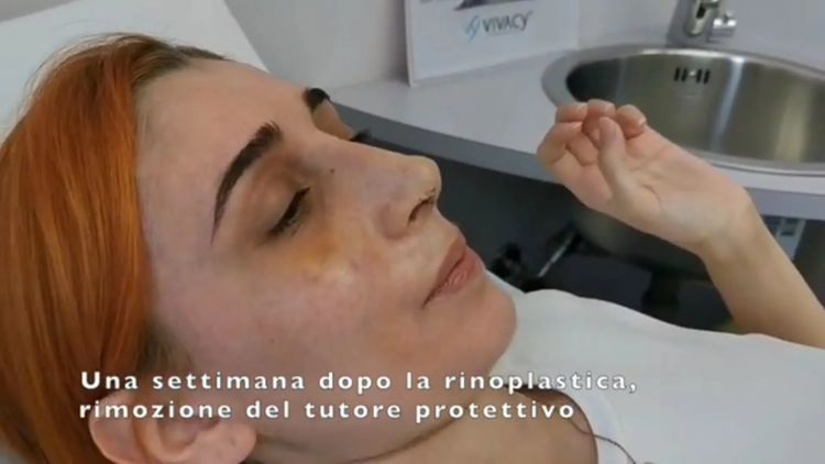 Rinosettoplastica - Dott. Francesco Alia