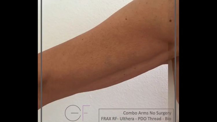 Combo Arms No Surgery - Dott.ssa Elena Fasola