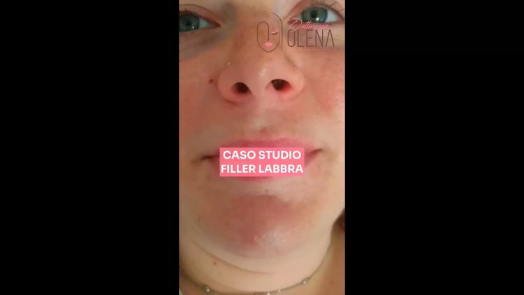 Caso studio Filler labbra - Dott.ssa Olena Zinchenko