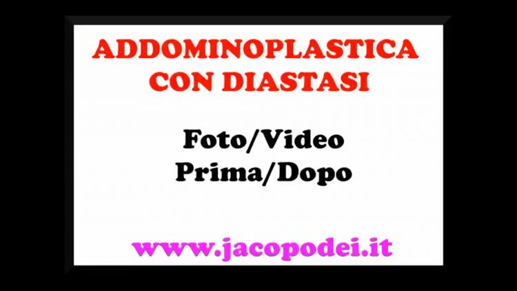 Addominoplastica con diatasi - Dott. Jacopo Dei