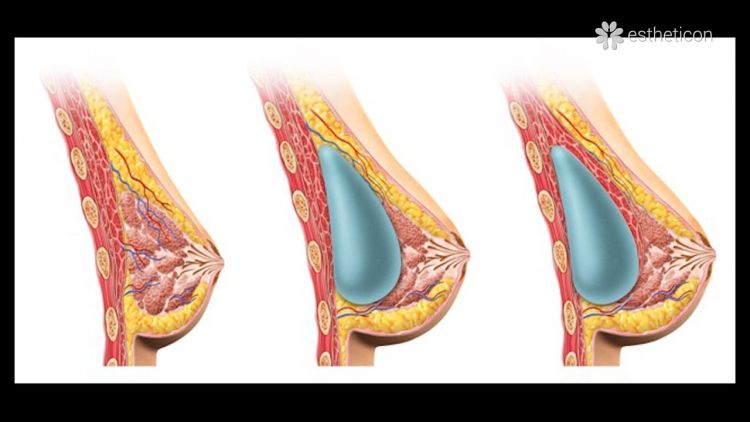 Mastoplastica additiva con il Dott. Campiglio