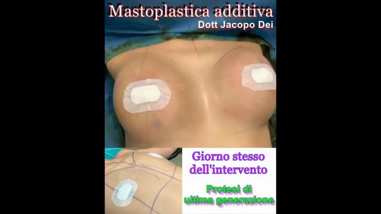 Dott. Dei - Mastoplastica additiva 