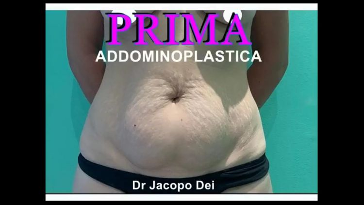 Dott. Jacopo Dei - Addominoplastica
